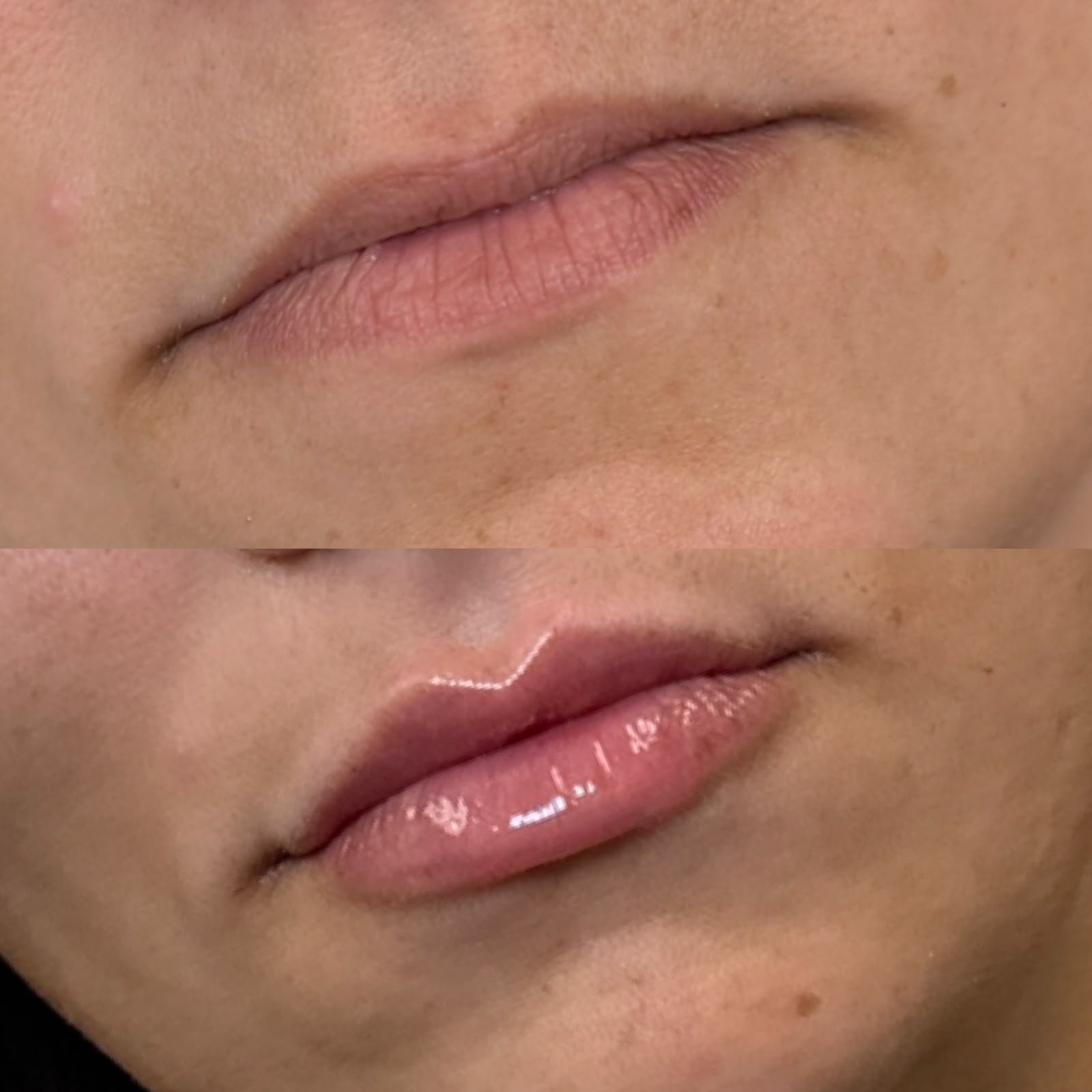 Lip filler patient result at Casa Contour MedSpa and Wellness