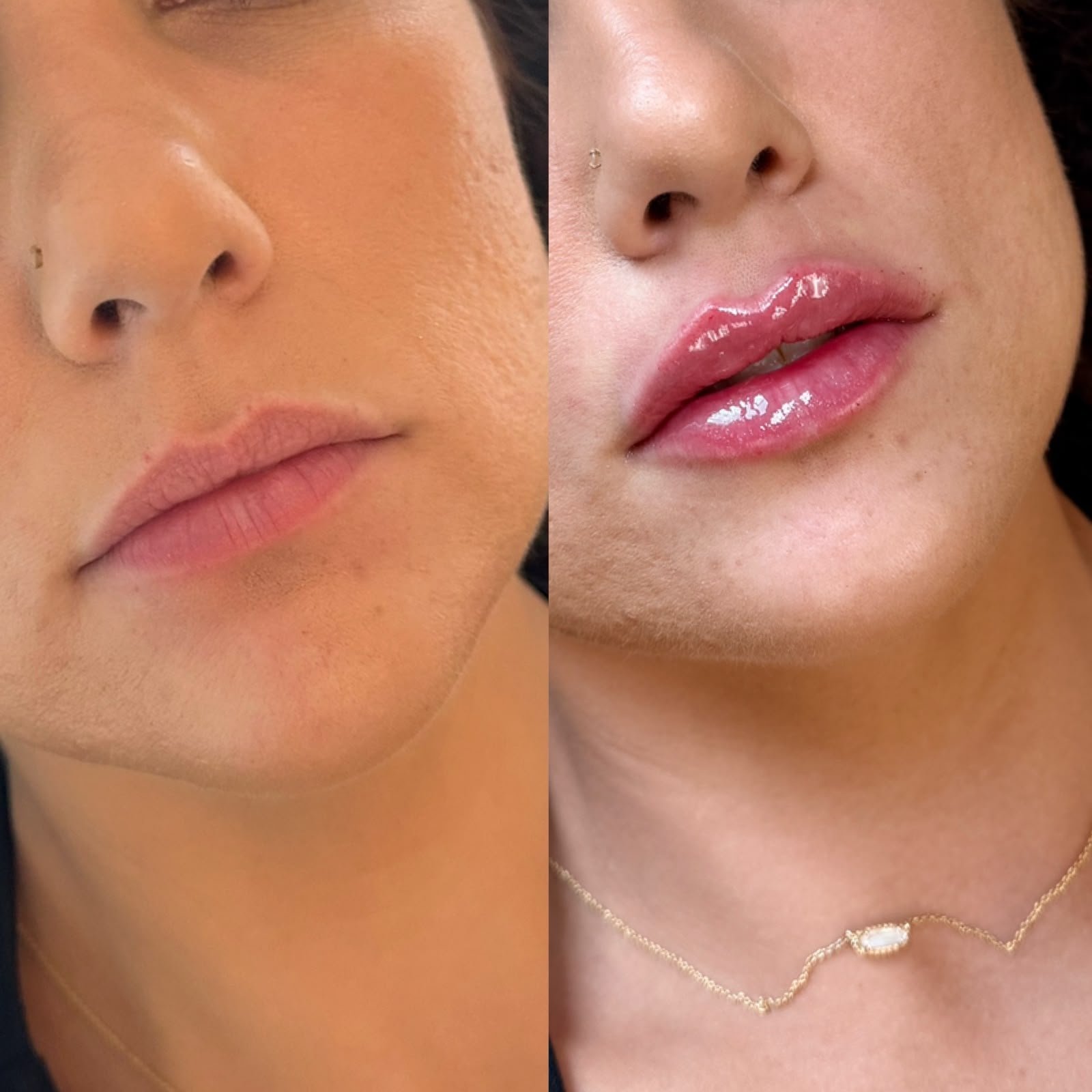 Casa Contour patient result 5