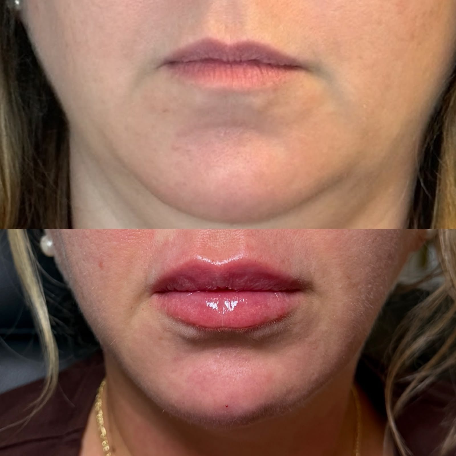 Natural looking lip filler result at Casa Contour