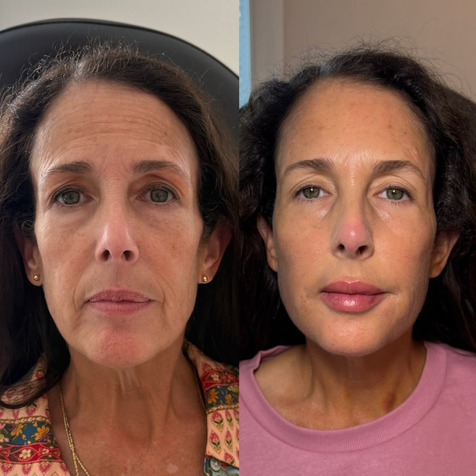 Casa Contour patient result 6