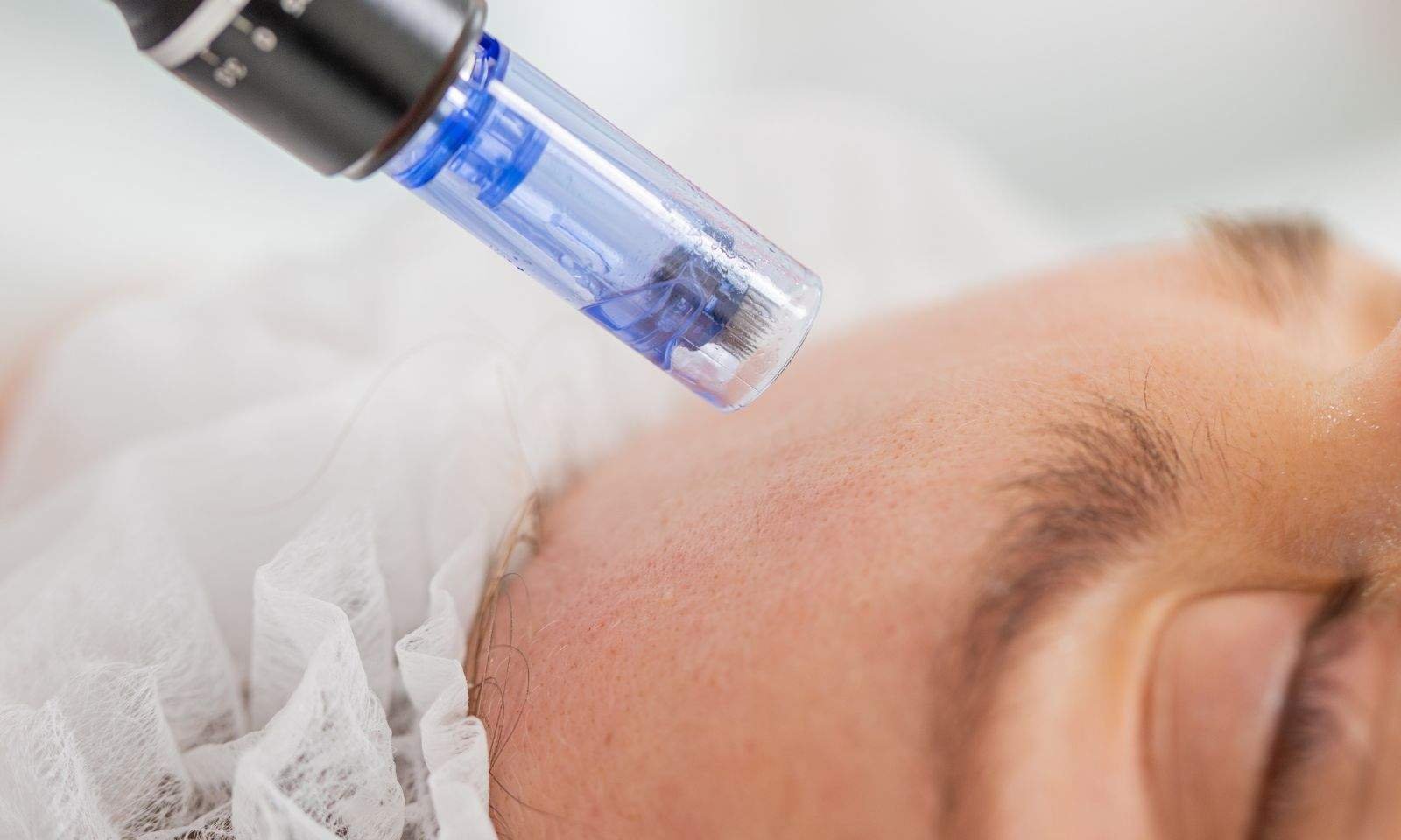 Microneedling skin treatment at Casa Contour MedSpa and Wellness in Virginia Beach