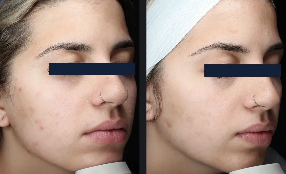 Glace treatment before and after result