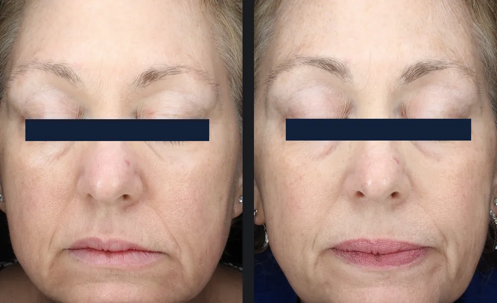 Glace treatment before and after result