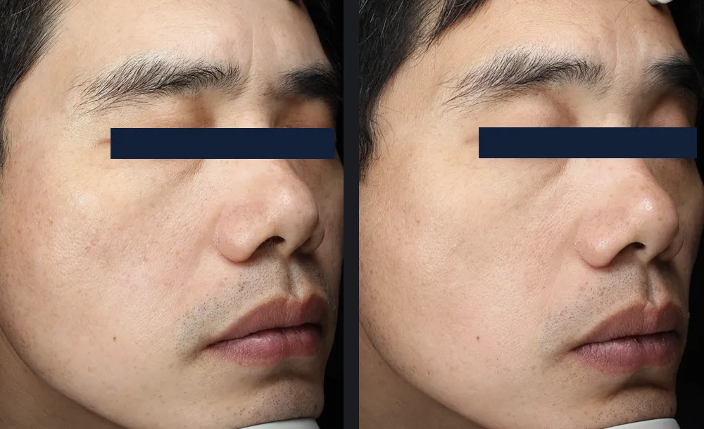 Glace treatment before and after result