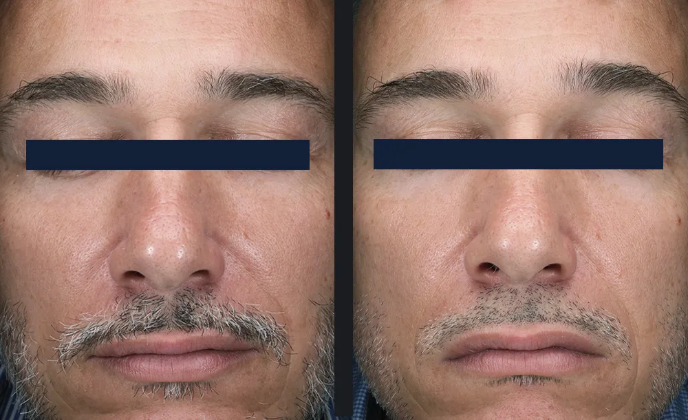 Glace treatment before and after result