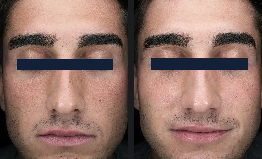 Glace treatment before and after result