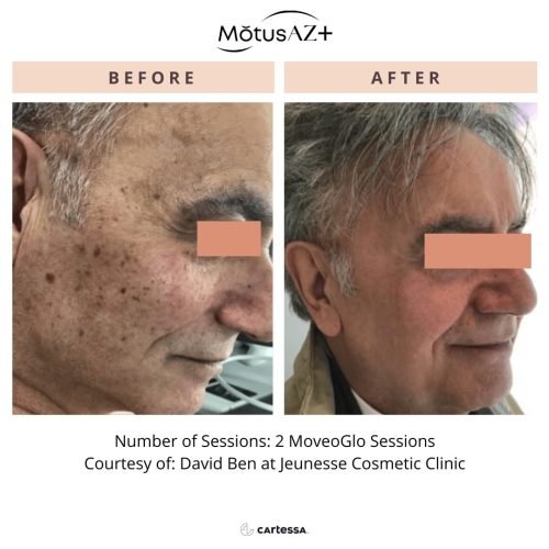 Moveo Glo laser skin rejuvenation treatment at Casa Contour in Virginia Beach